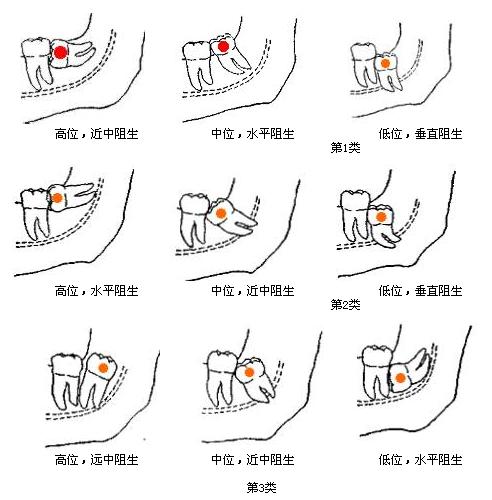 当前位置:青山湖陈庆华口腔门诊部 >> 首页 下颌 智齿能够正常萌出